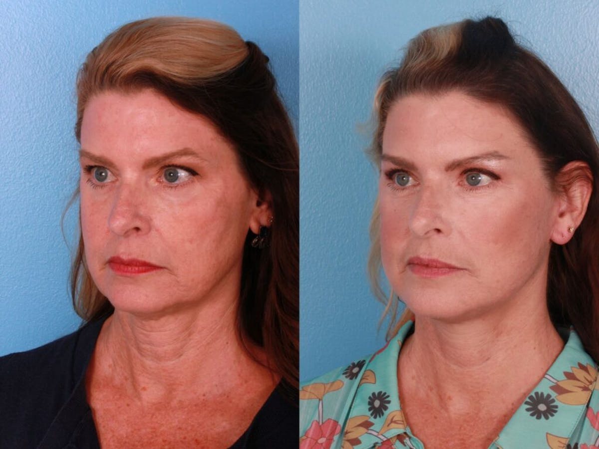 Limited Incision Facelift Before & After Gallery - Patient 100018 - Image 2