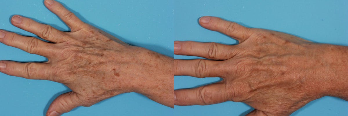 Lasers Before & After Gallery - Patient 401193 - Image 2