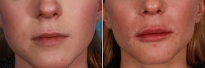 Juvederm Before & After Gallery - Patient 365331 - Image 1