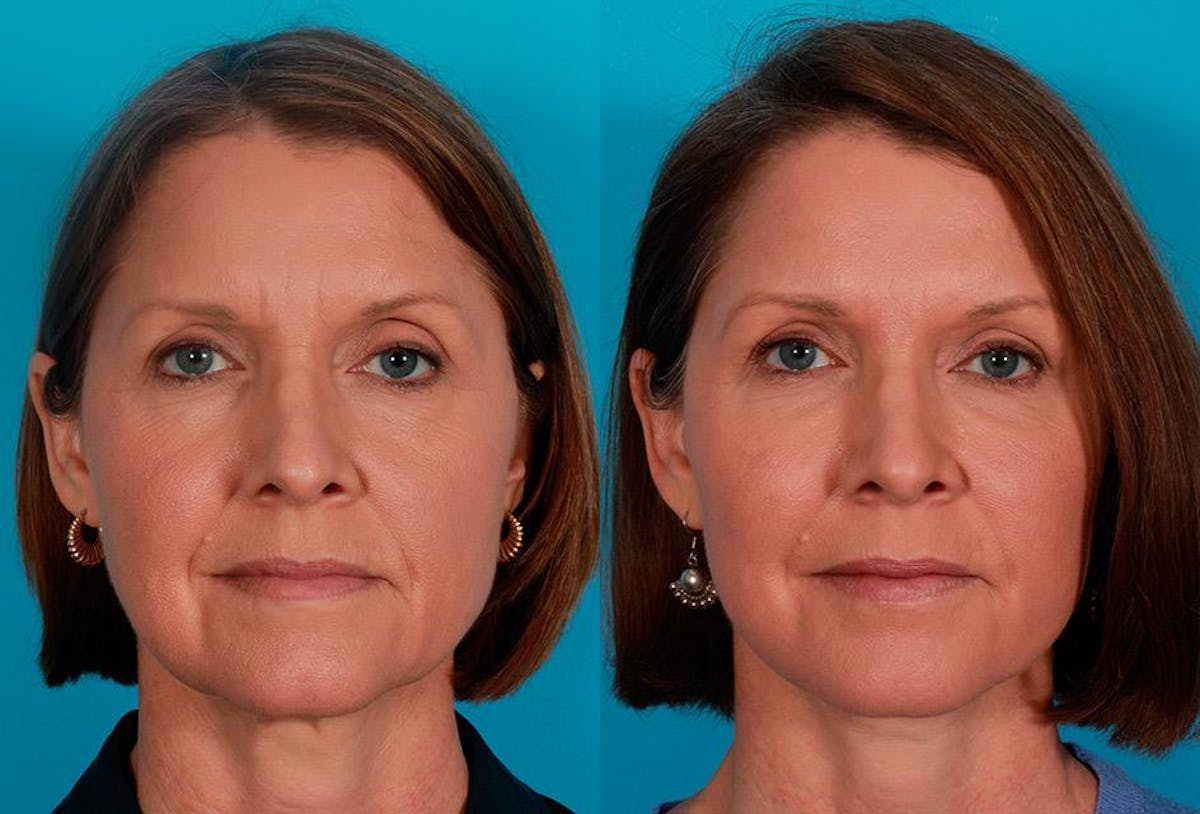 Facial Fat Transfer Before & After Gallery - Patient 269487 - Image 1