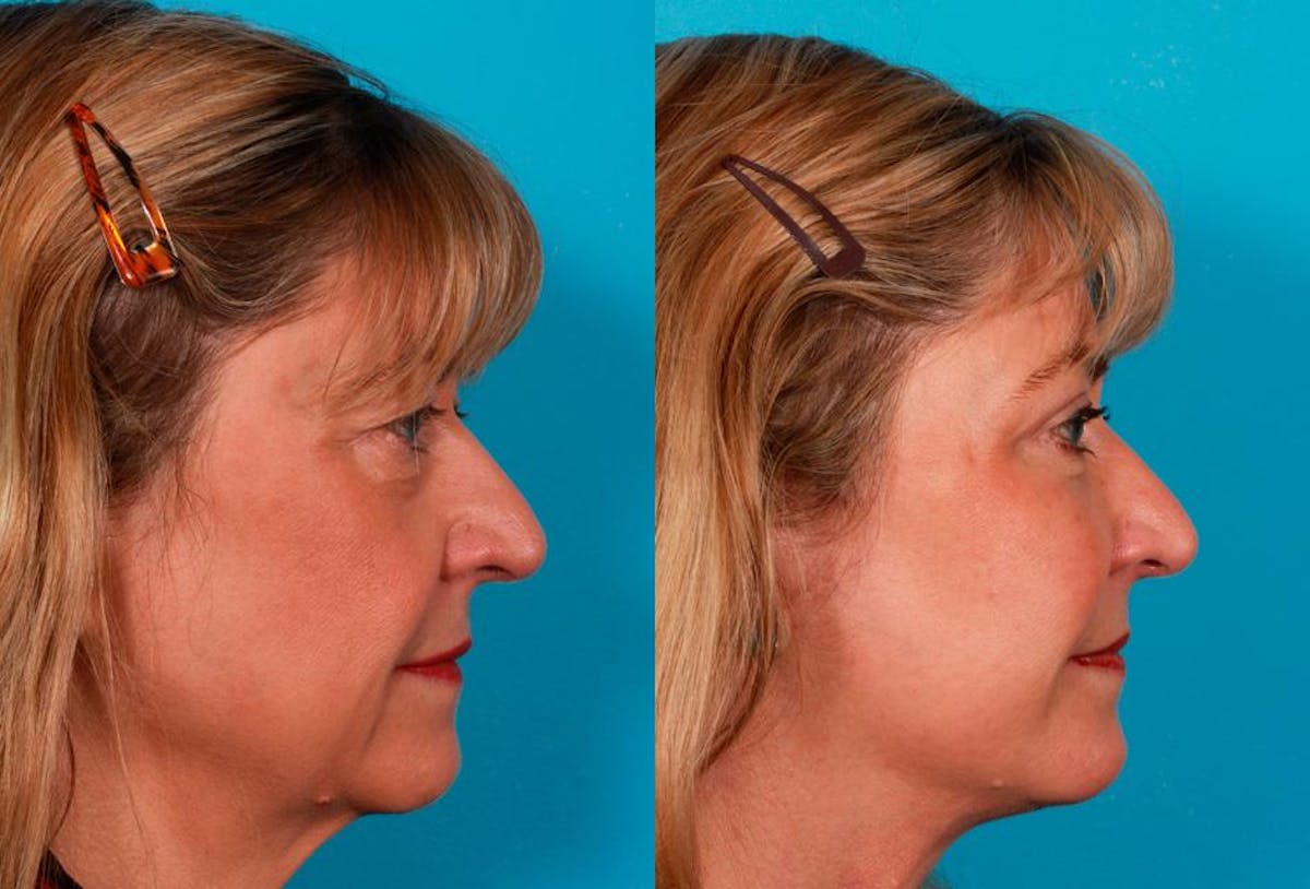 Facelift Before & After Gallery - Patient 123573 - Image 3