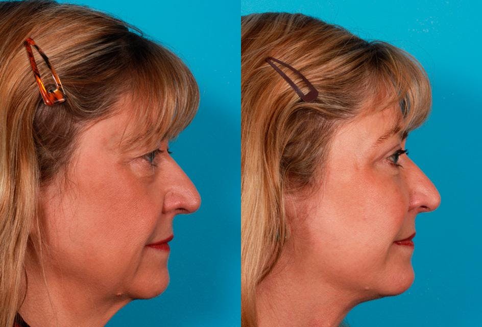 Facelift Before & After Gallery - Patient 123573 - Image 3