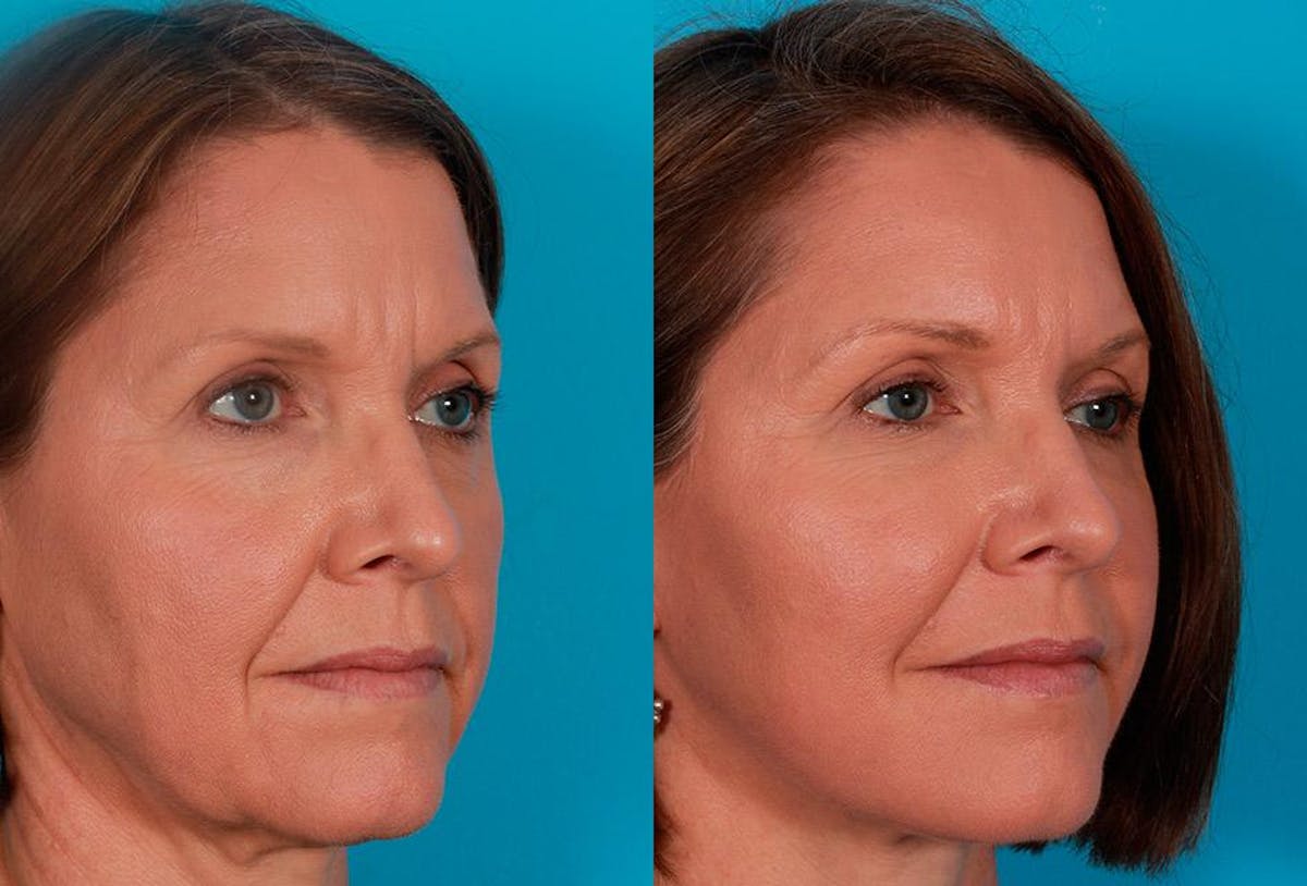 Facial Fat Transfer Before & After Gallery - Patient 269487 - Image 2