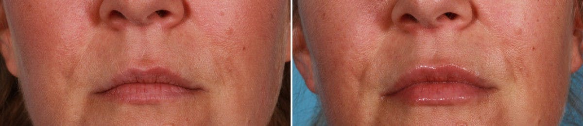 Juvederm Before & After Gallery - Patient 146305 - Image 1