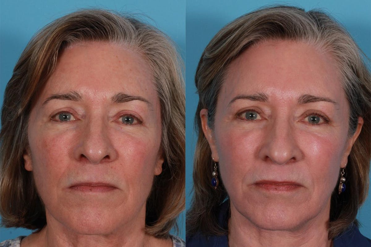 Lasers Before & After Gallery - Patient 116816 - Image 1