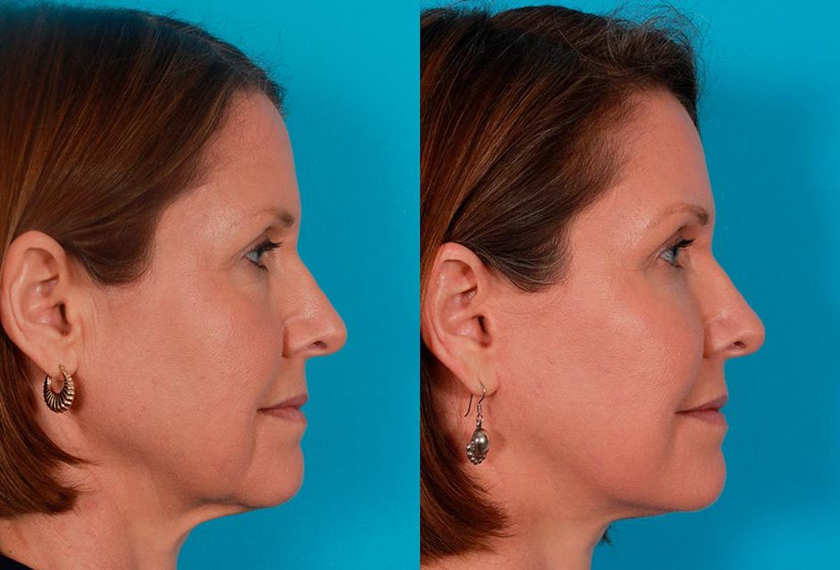 Facial Fat Transfer Before & After Gallery - Patient 269487 - Image 3