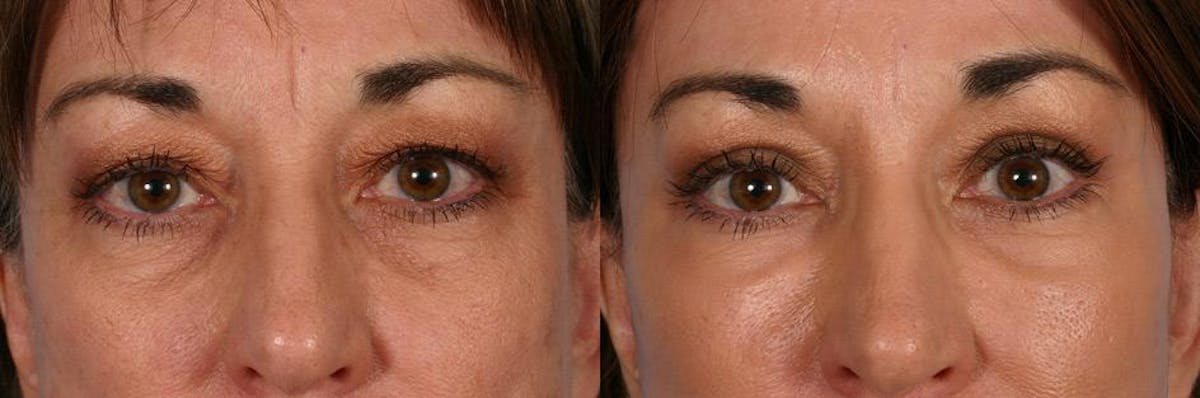 Eyelid Surgery (Blepharoplasty) Before & After Gallery - Patient 120503 - Image 4