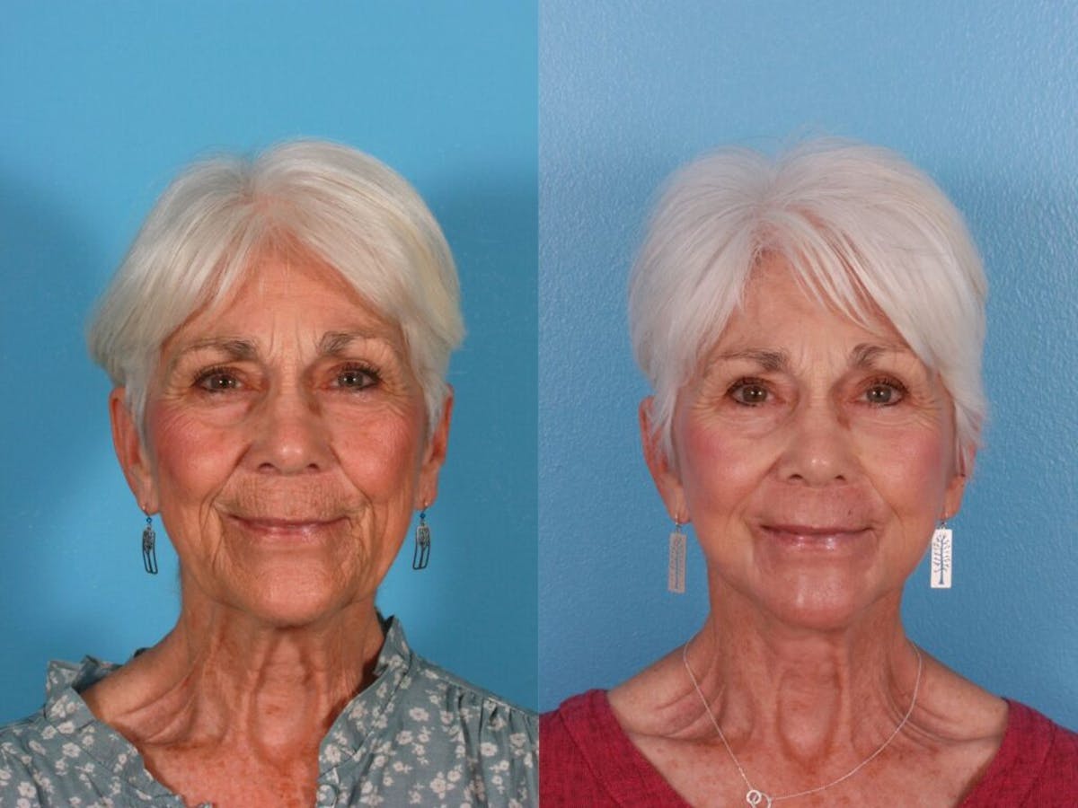 Limited Incision Facelift Before & After Gallery - Patient 271634 - Image 1
