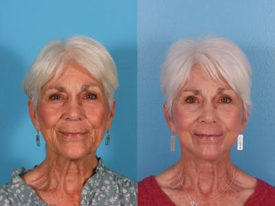 Limited Incision Facelift Before & After Gallery - Patient 271634 - Image 1