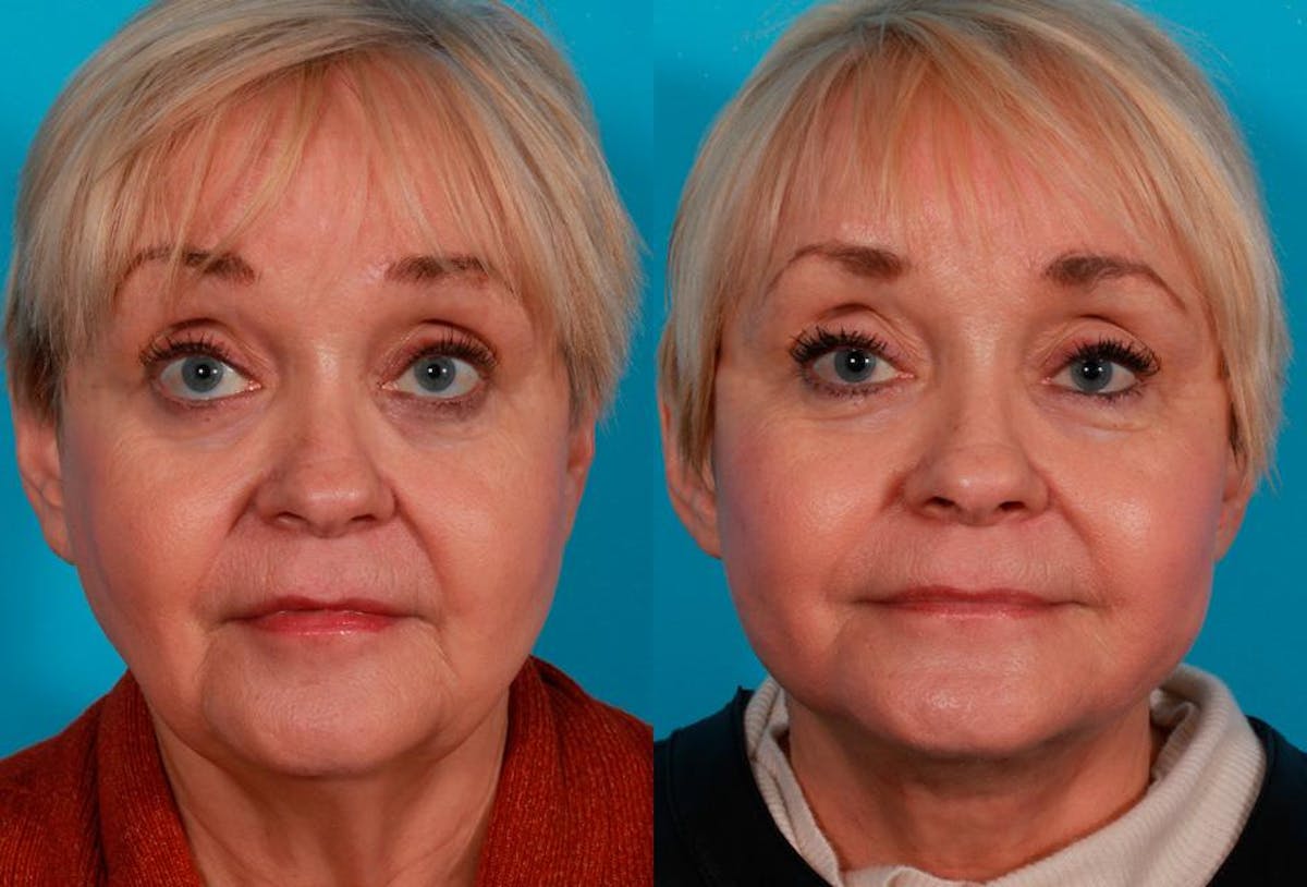 Facelift Before & After Gallery - Patient 319337 - Image 1