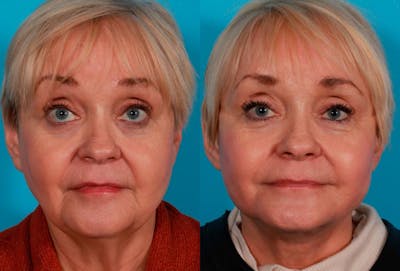 Facelift Before & After Gallery - Patient 319337 - Image 1