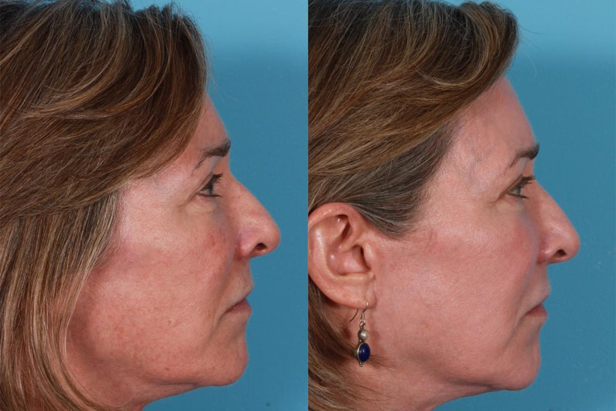 Lasers Before & After Gallery - Patient 116816 - Image 2
