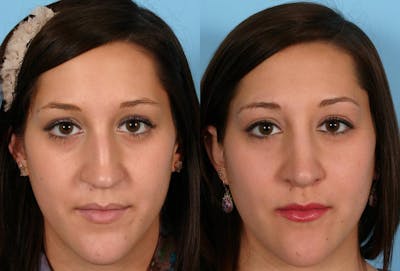 Rhinoplasty Before & After Gallery - Patient 389038 - Image 1
