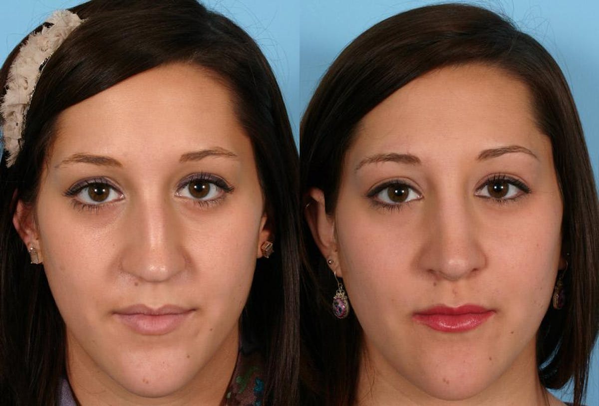 Rhinoplasty Before & After Gallery - Patient 389038 - Image 1