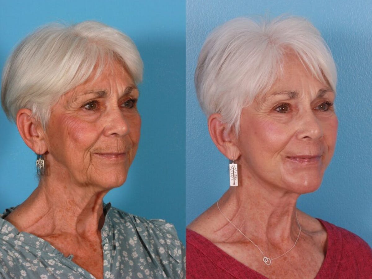 Limited Incision Facelift Before & After Gallery - Patient 271634 - Image 2