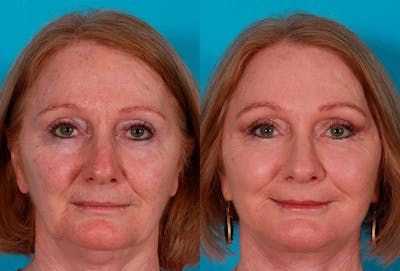 Facial Fat Transfer Before & After Gallery - Patient 227639 - Image 1
