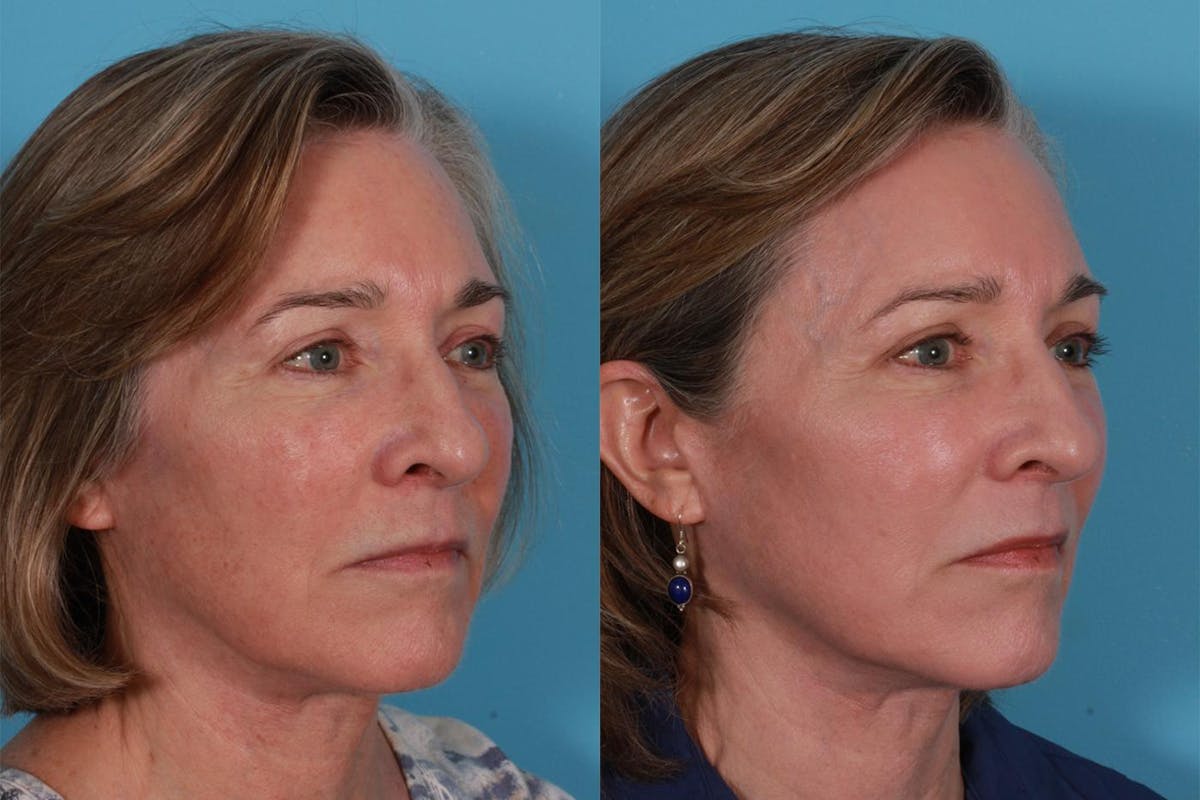 Lasers Before & After Gallery - Patient 116816 - Image 3