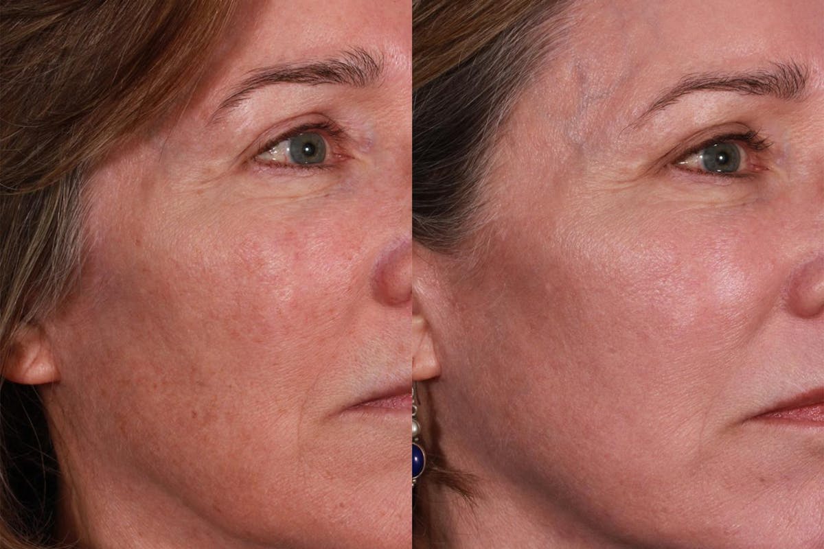 Lasers Before & After Gallery - Patient 116816 - Image 4