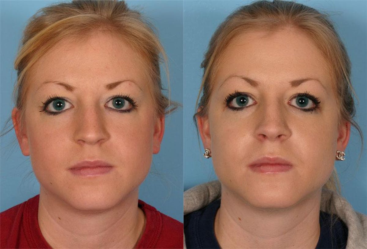 Rhinoplasty Before & After Gallery - Patient 410963 - Image 1