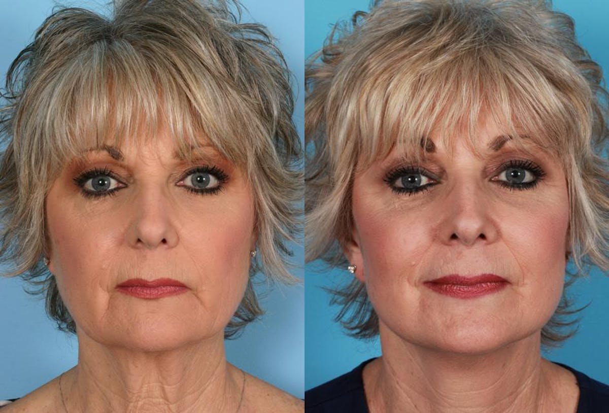 Limited Incision Facelift Before & After Gallery - Patient 851036 - Image 1