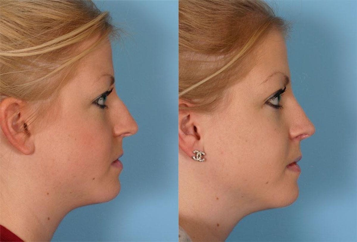 Rhinoplasty Before & After Gallery - Patient 410963 - Image 2