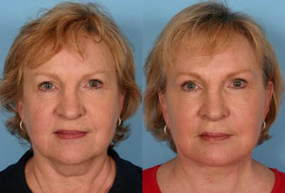 TCA Peel / Dermabrasion Before & After Gallery - Patient 191560 - Image 1