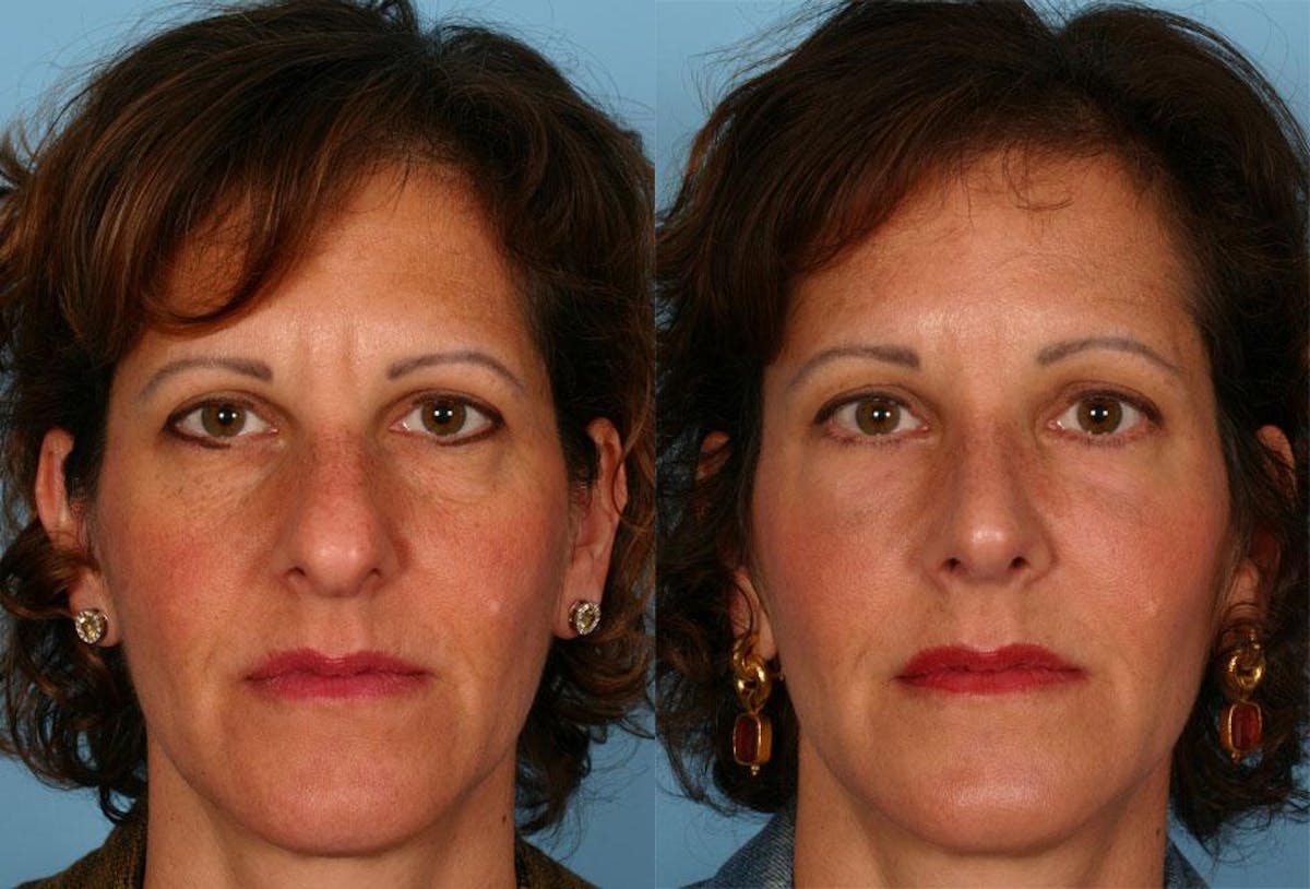 Facial Fat Transfer Before & After Gallery - Patient 468574 - Image 1