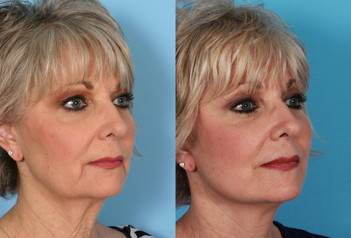 Limited Incision Facelift Before & After Gallery - Patient 851036 - Image 2