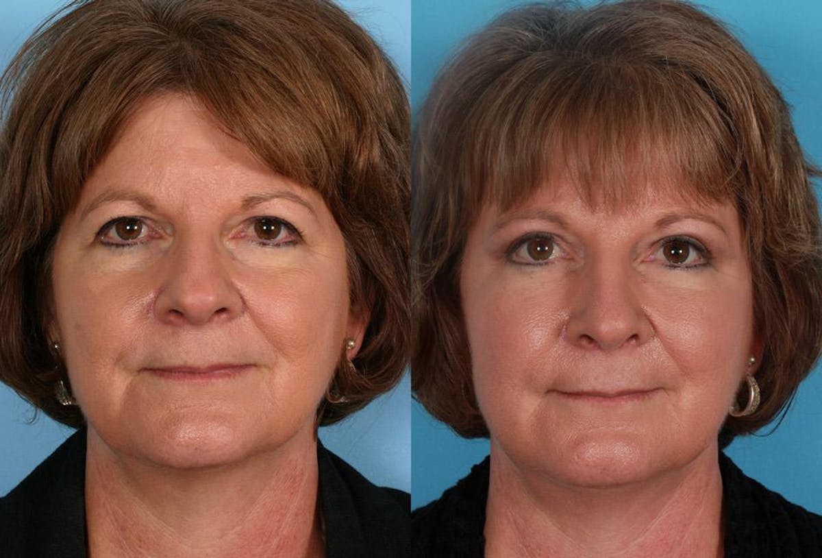 Rhinoplasty Before & After Gallery - Patient 140798 - Image 1