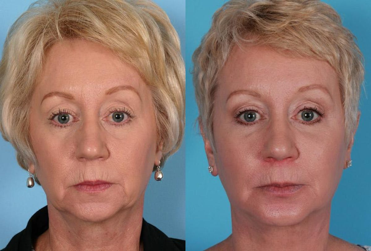 Eyelid Surgery (Blepharoplasty) Before & After Gallery - Patient 397661 - Image 1