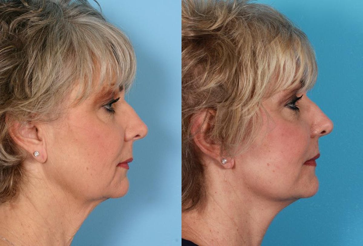 Limited Incision Facelift Before & After Gallery - Patient 851036 - Image 3