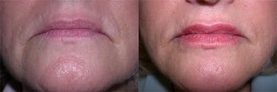 Lip Augmentation Before & After Gallery - Patient 396207 - Image 1