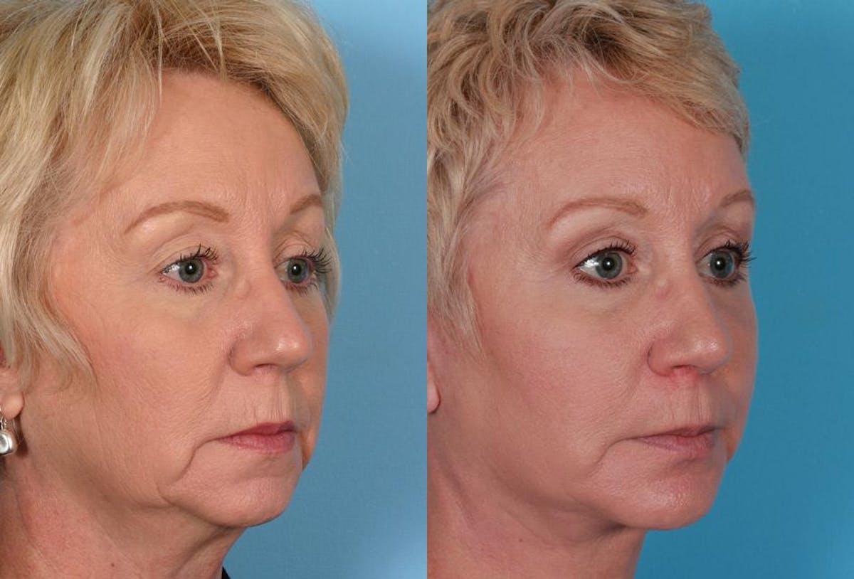 Eyelid Surgery (Blepharoplasty) Before & After Gallery - Patient 397661 - Image 2