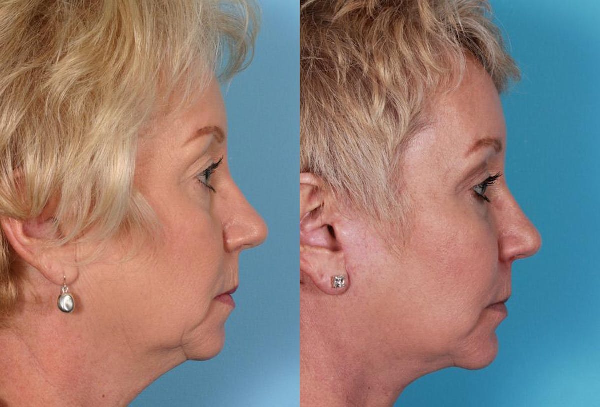 Eyelid Surgery (Blepharoplasty) Before & After Gallery - Patient 397661 - Image 3