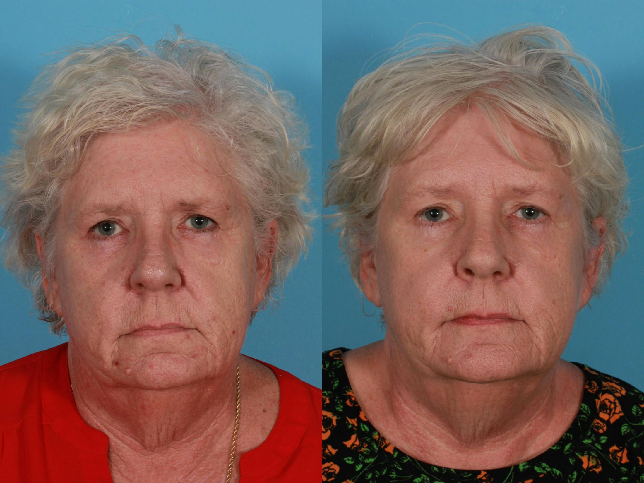 Lasers Before & After Gallery - Patient 326154 - Image 1
