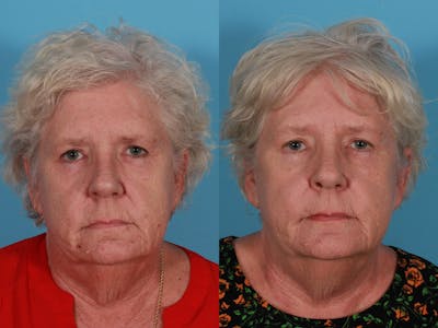 Lasers Before & After Gallery - Patient 326154 - Image 1