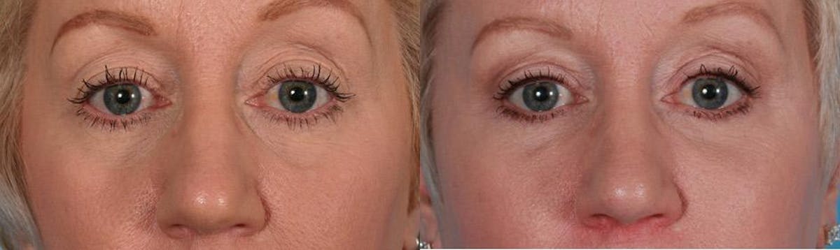Eyelid Surgery (Blepharoplasty) Before & After Gallery - Patient 397661 - Image 4