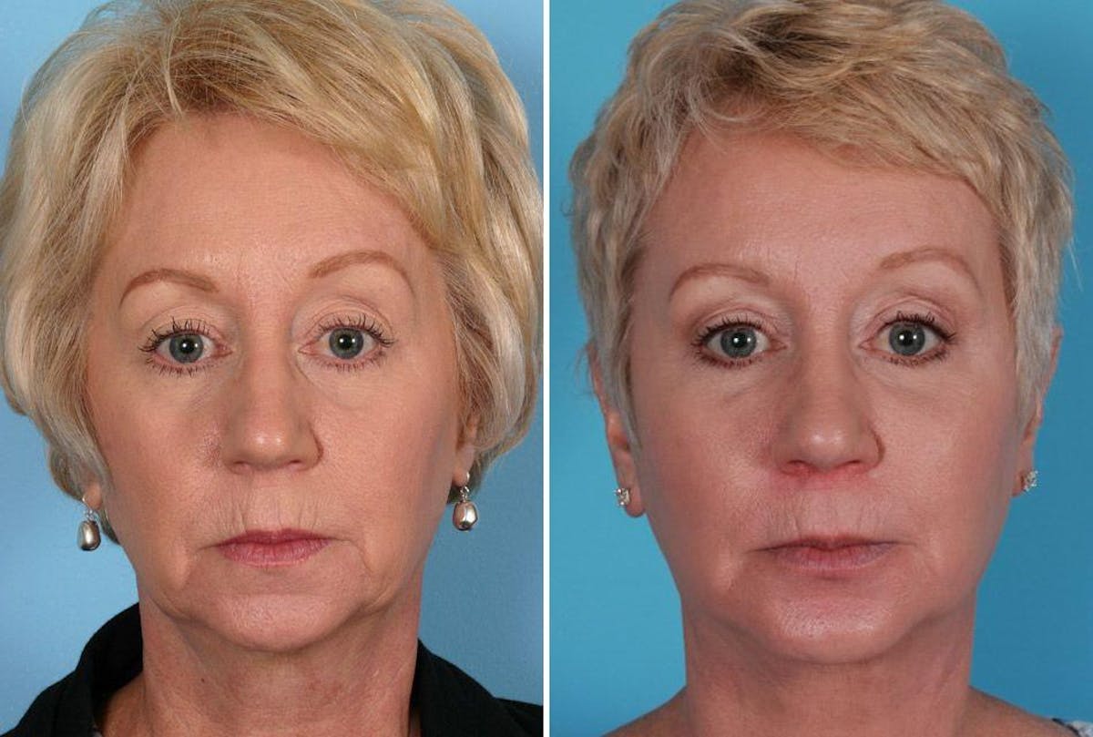 Eyelid Surgery (Blepharoplasty) Before & After Gallery - Patient 397661 - Image 5