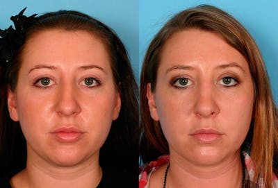 Rhinoplasty Before & After Gallery - Patient 127946 - Image 1