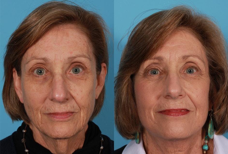 Facelift Before & After Gallery - Patient 262271 - Image 1