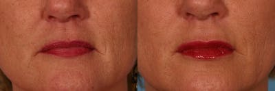 Lip Augmentation Before & After Gallery - Patient 409337 - Image 1