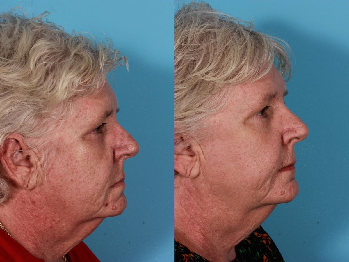 Lasers Before & After Gallery - Patient 326154 - Image 2