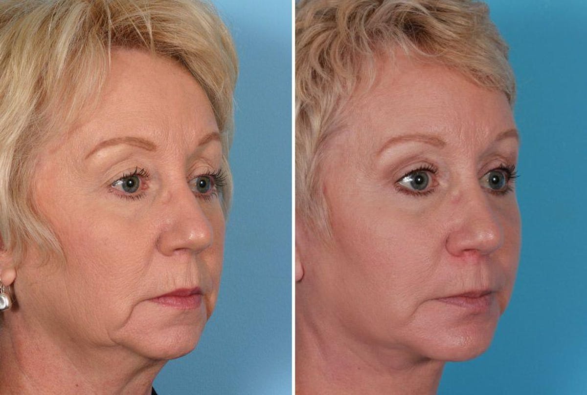 Eyelid Surgery (Blepharoplasty) Before & After Gallery - Patient 397661 - Image 6