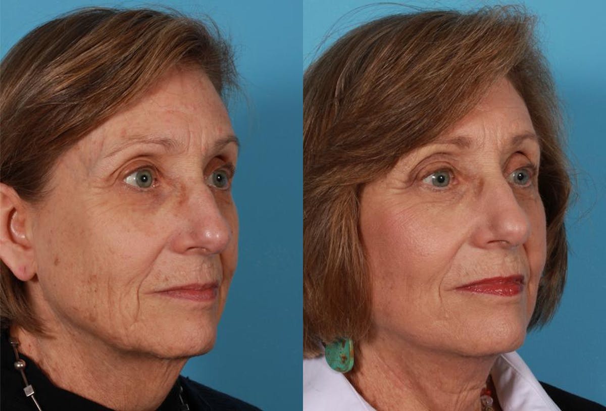 Facelift Before & After Gallery - Patient 262271 - Image 2