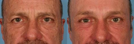 TCA Peel / Dermabrasion Before & After Gallery - Patient 222260 - Image 4