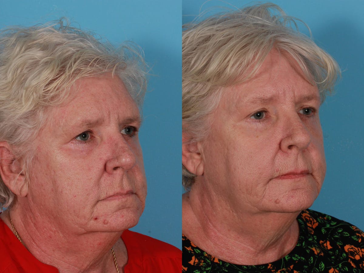 Lasers Before & After Gallery - Patient 326154 - Image 3
