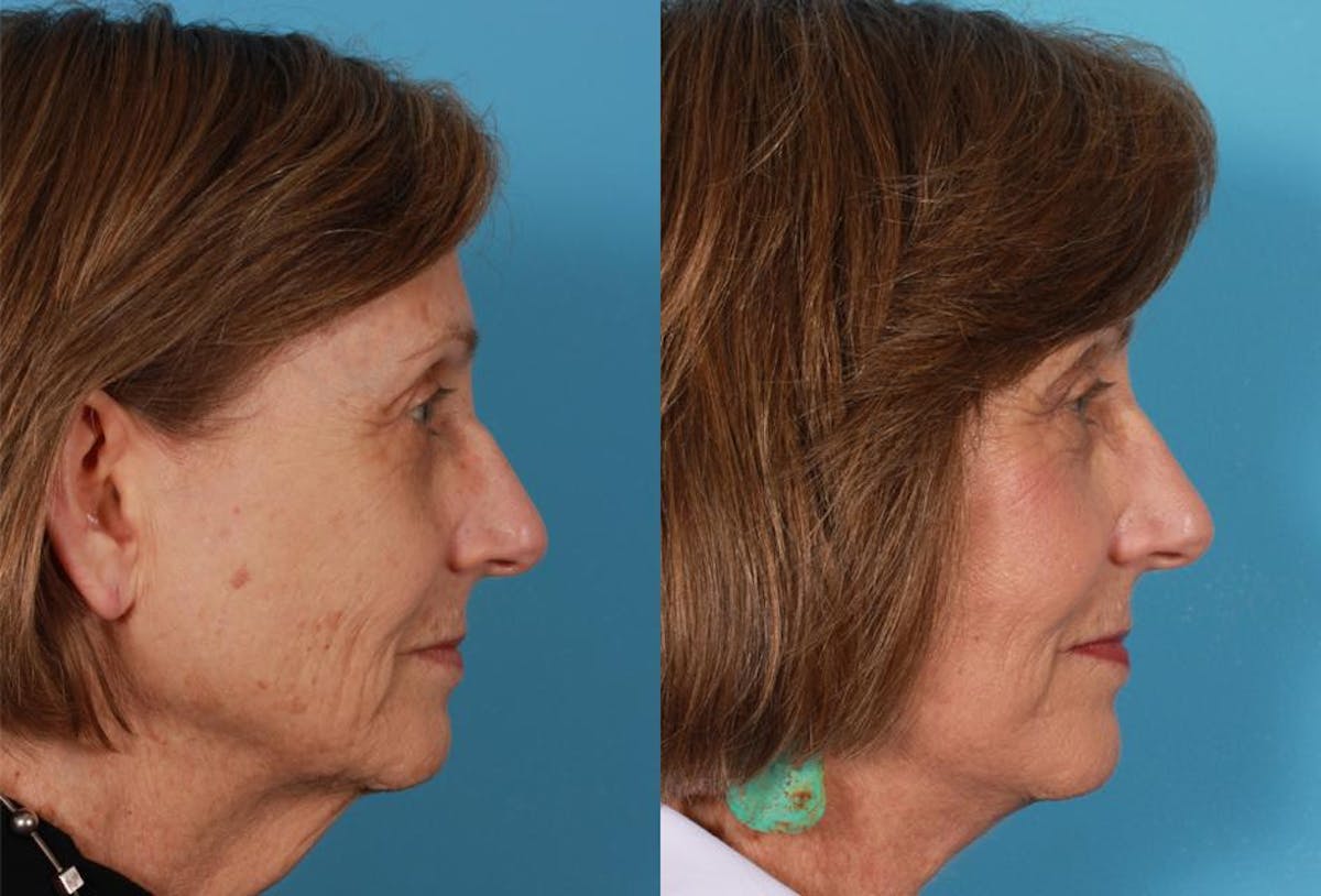 Facelift Before & After Gallery - Patient 262271 - Image 3