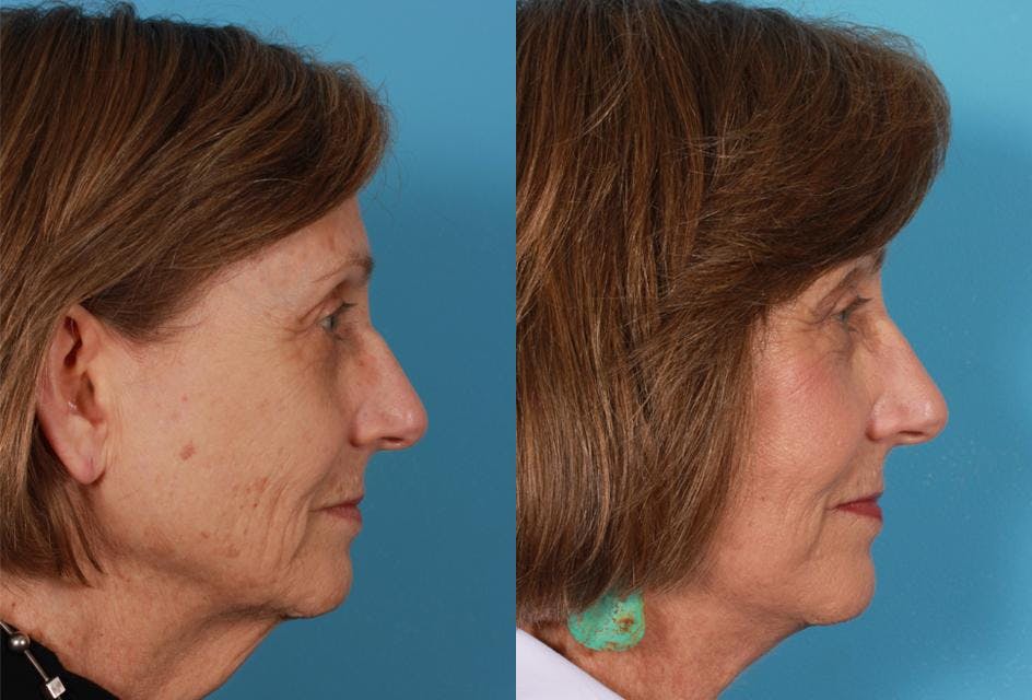 Facelift Before & After Gallery - Patient 262271 - Image 3