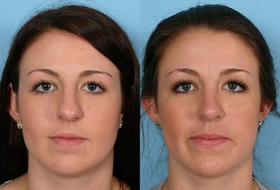 Rhinoplasty Before & After Gallery - Patient 558721 - Image 1