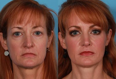 Restylane Before & After Gallery - Patient 903628 - Image 1